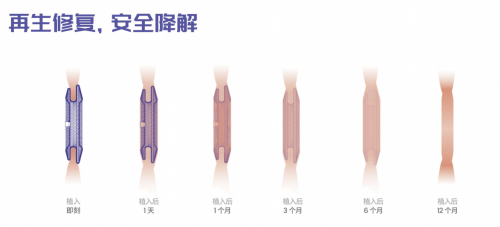 正式啟動臨床應(yīng)用！全國首批生物可降解房缺封堵術(shù)圓滿成功！  第2張